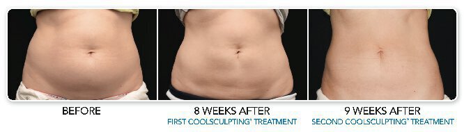 Coolsculting before and after pictures